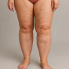 Compreendendo o Lipedema